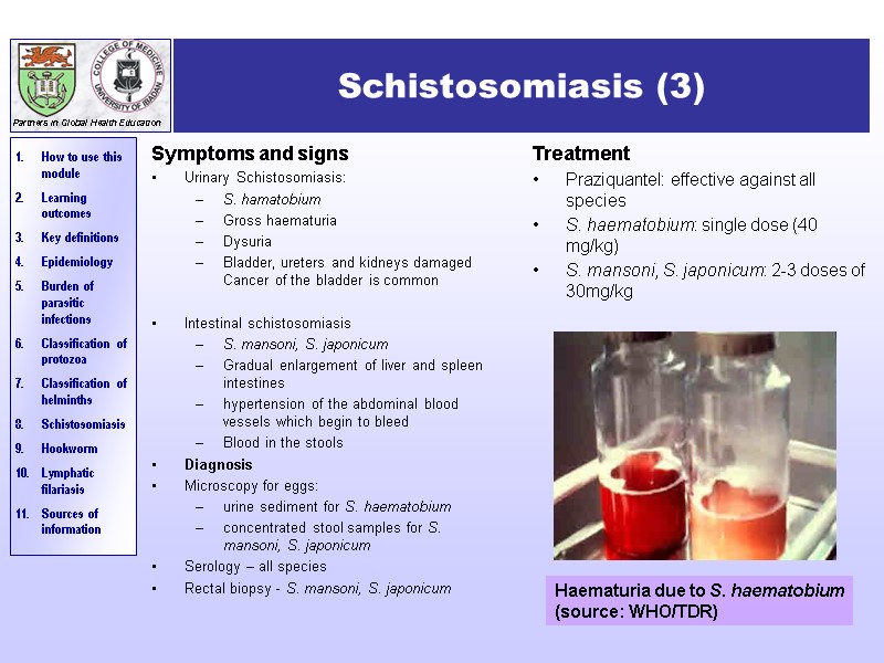 Schistosomiasis (3) Symptoms and signs Urinary Schistosomiasis: S. hamatobium Gross haematuria Dysuria Bladder, ureters